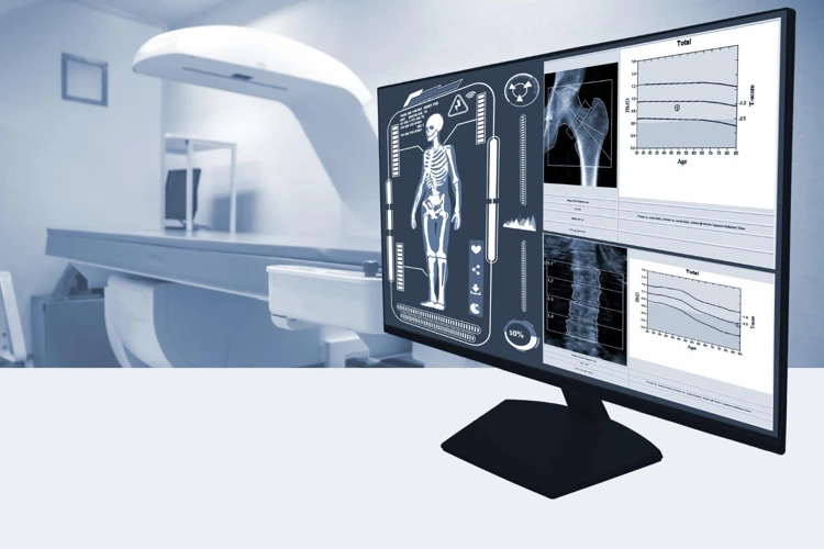 Monitor showing hip and spine bone density scan images beside a DEXA scanner