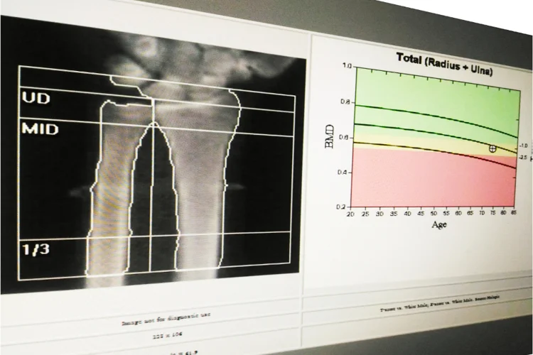 Bone mineral density report showing a scan image beside a BMD reference graph