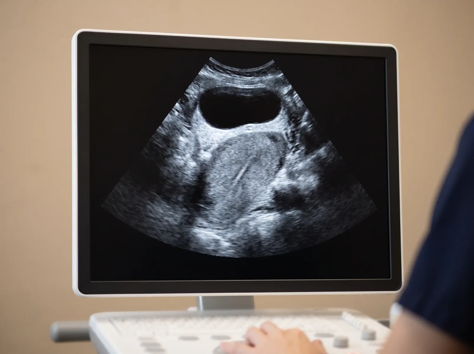 Close-up of an ultrasound screen showing a pelvic scan of the uterus and bladder