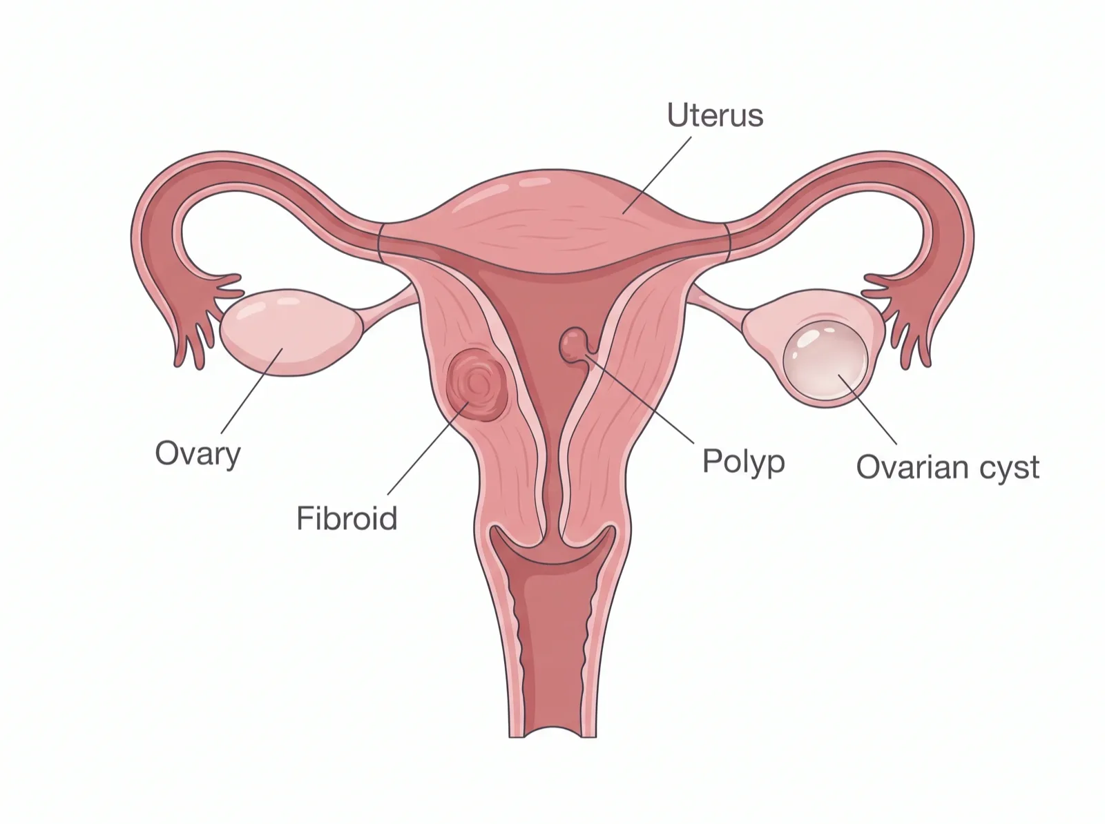 Illustration of the uterus and ovaries with an ovarian cyst, fibroid and polyp