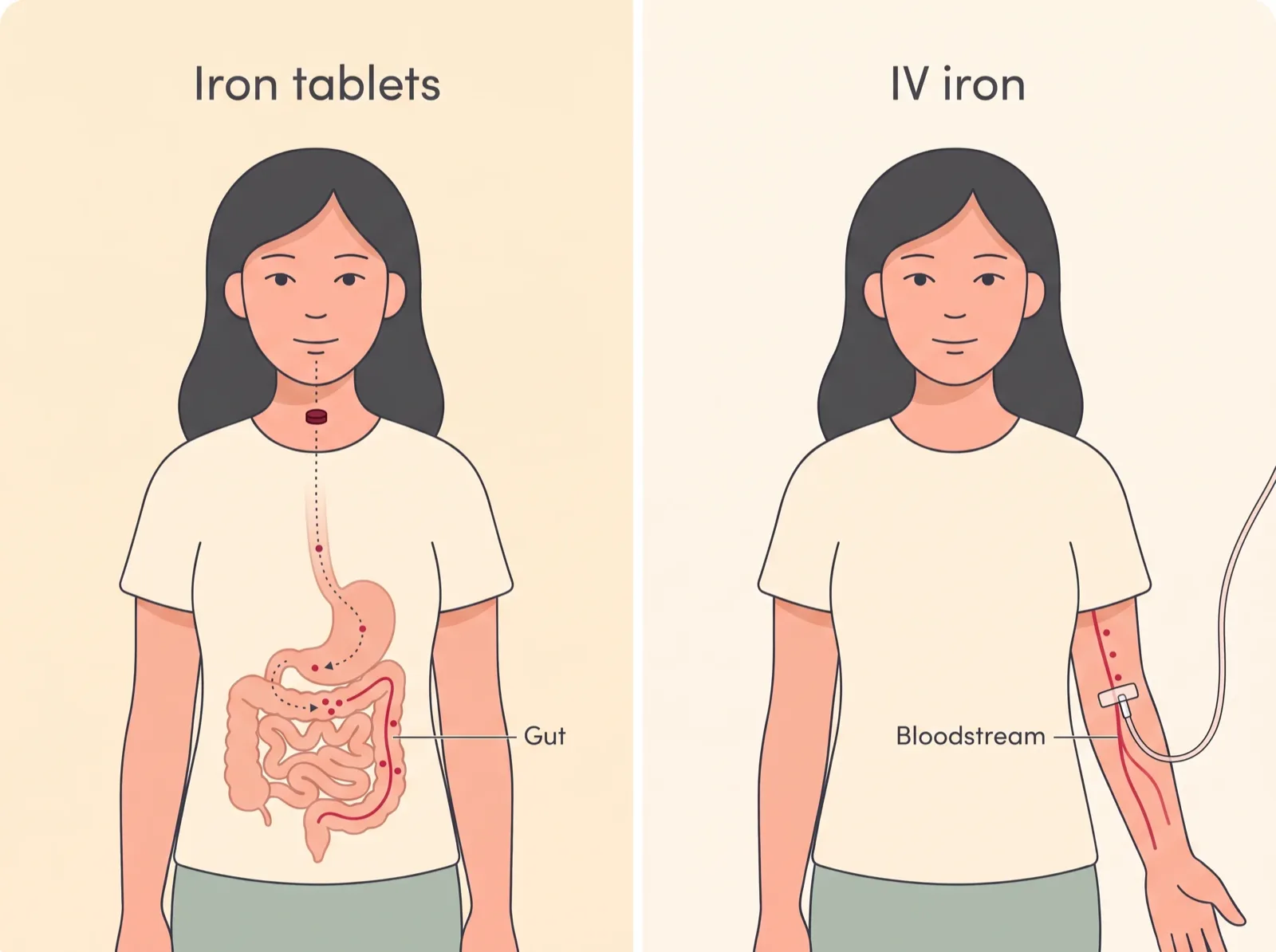 Illustration of iron tablets absorbed through the gut versus IV iron into a vein