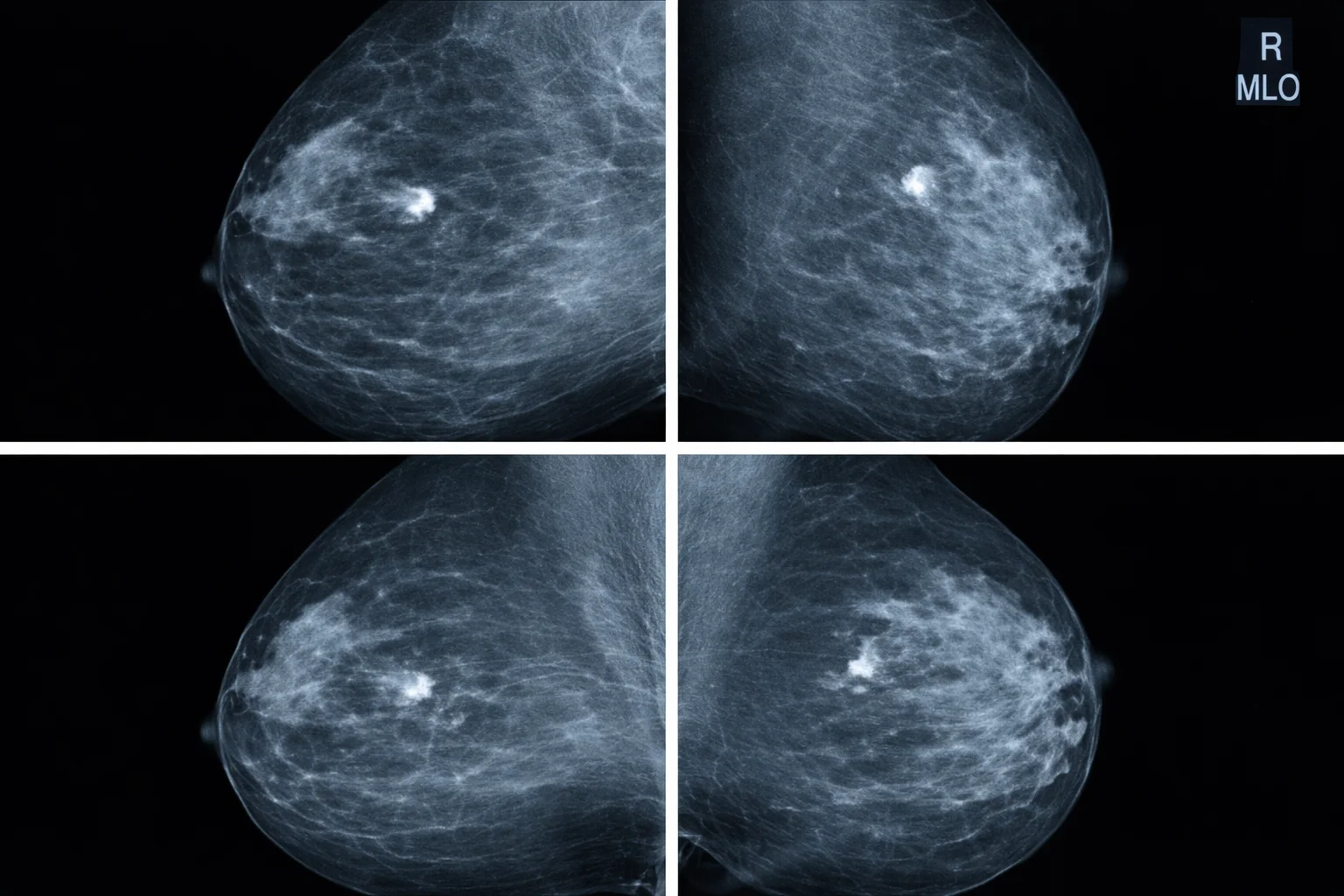 Four mammogram scan images showing different views of breast tissue
