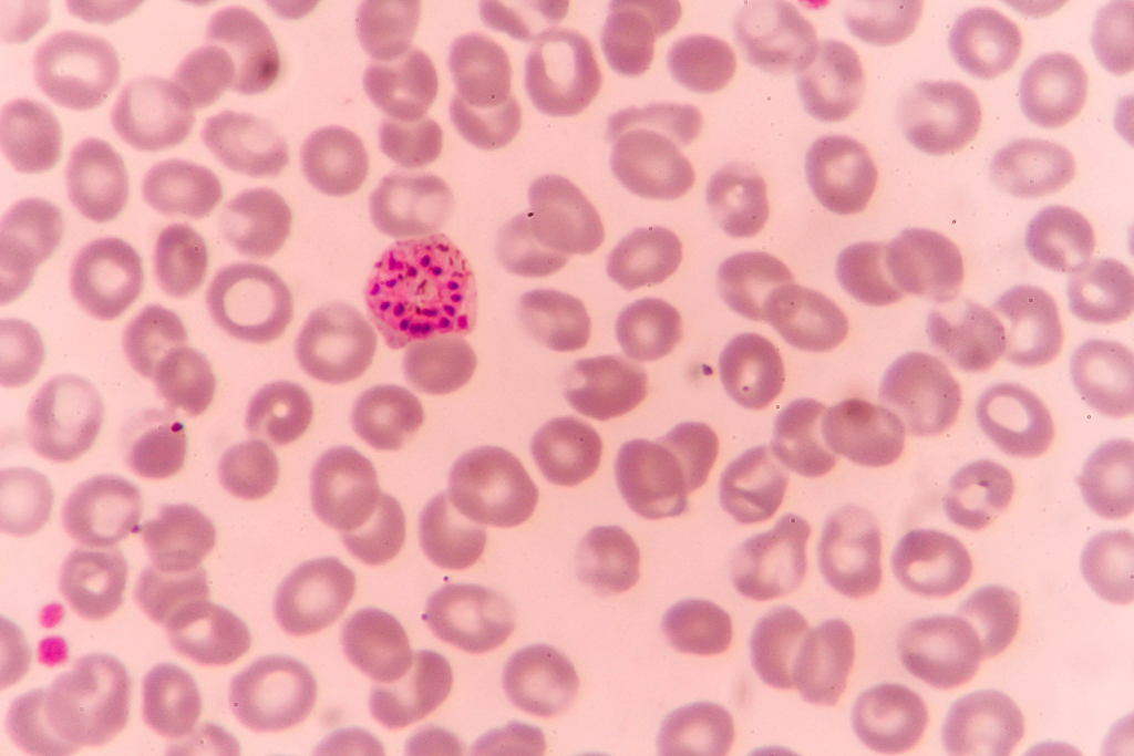 Microscopic image showing Plasmodium parasites infecting red blood cells causing malaria in person.