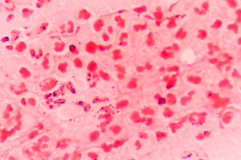 Microscopic view of neisseria gonorrhoea which is sexually transmitted and causes gonorrhoea. 