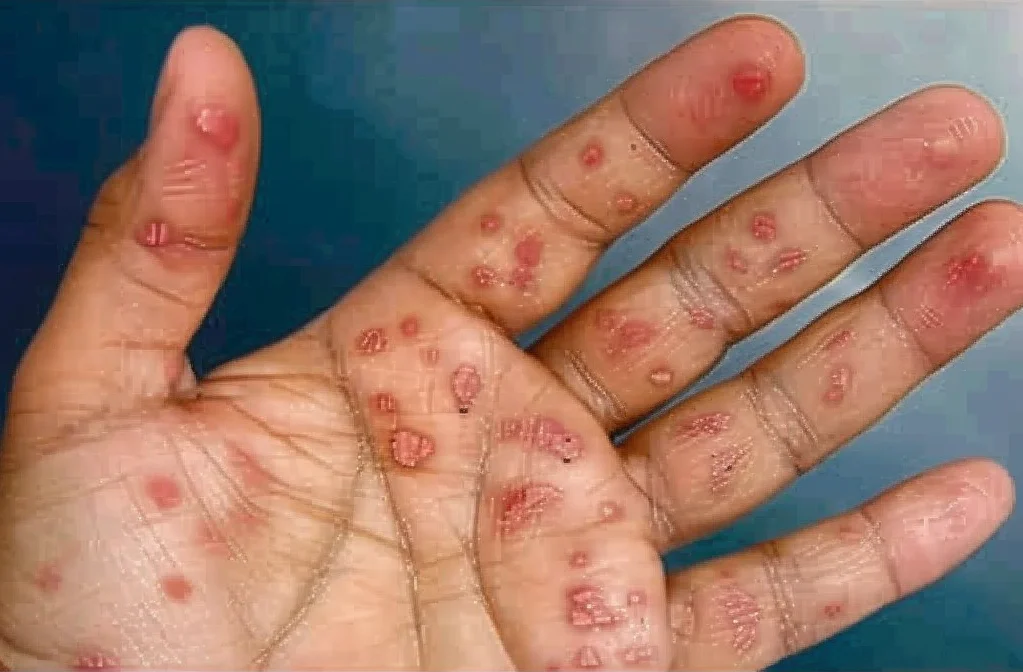 Syphilis secondary stage hand rash showing non itchy sores on palms linked to bacterial infection.