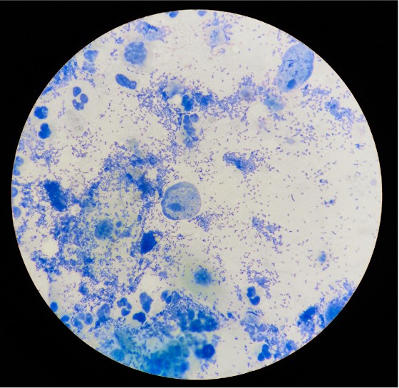 Trichomonas vaginalis parasite seen in stained microscopic slide showing cellular structure.