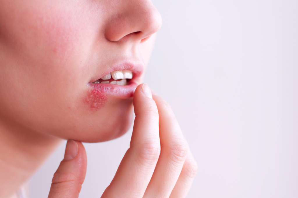 Woman with visible oral herpes lesion on lower lip showing early symptoms of hsv 1 infection.