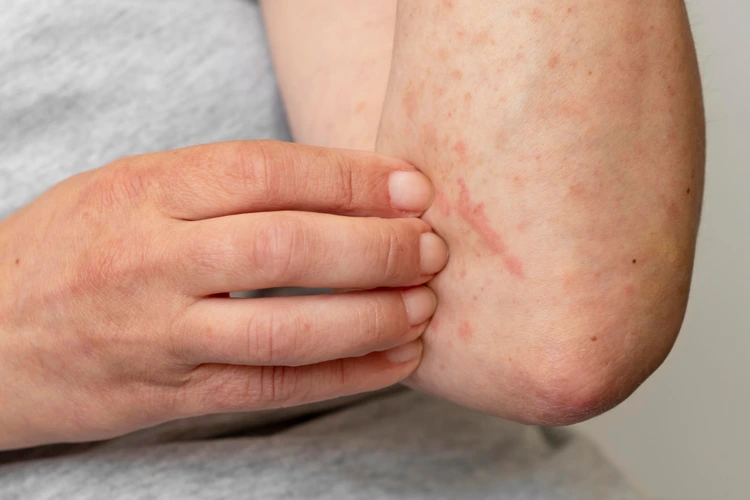 Measles skin rash on arm of infected person