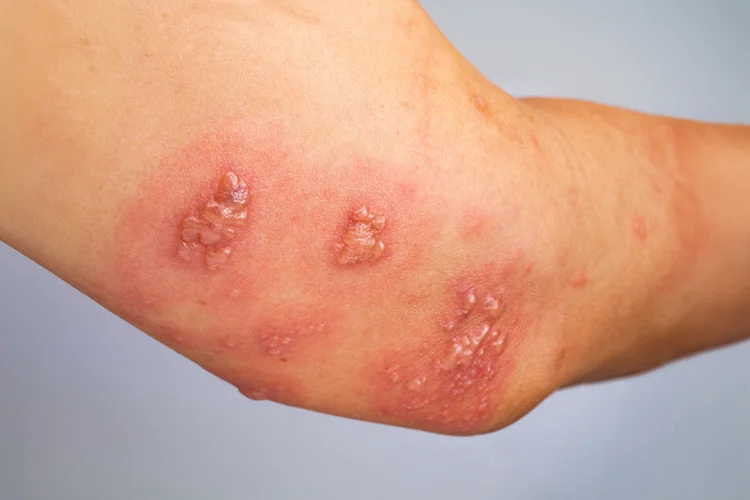 Painful shingles rash with blisters on an arm caused by reactivation of the varicella-zoster virus.